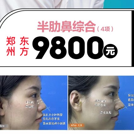 鄭州東方整形鼻子多少錢？李冰肋骨鼻9800起雙專利技術(shù)更自然