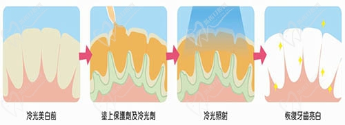 冷光美白過程