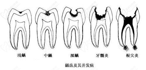 齲齒發(fā)展