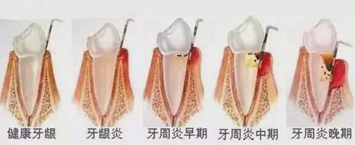 牙周炎發(fā)展