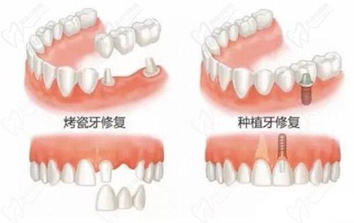 全口假牙修復(fù)