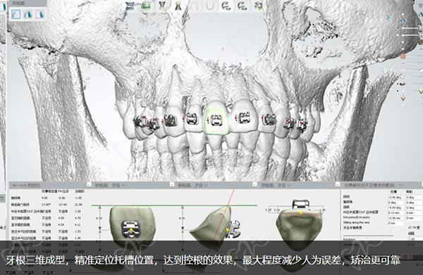 德倫口腔矯正牙齒怎么樣正畸模擬設(shè)計(jì)