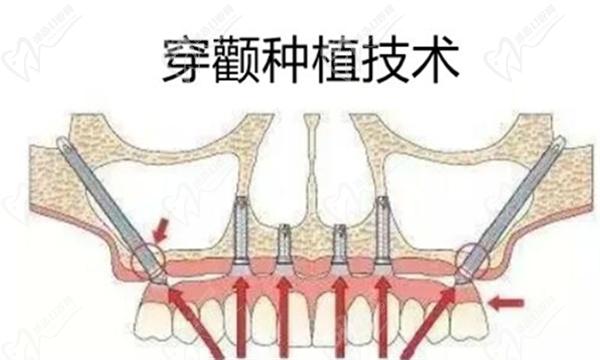 穿顴種植