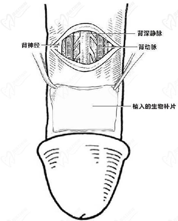 生物補片增粗手術<span style=