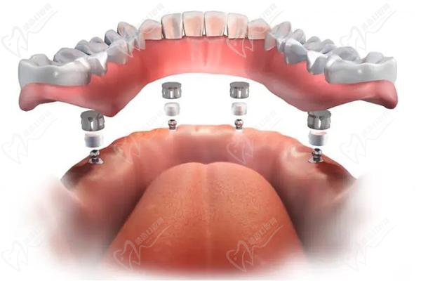 廣州曙光美云口腔醫(yī)院全口種牙怎么樣