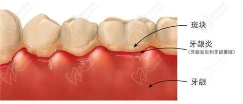 牙齦發(fā)炎怎么辦