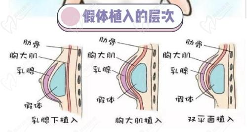 謝衛(wèi)國隆胸技術(shù)怎么樣