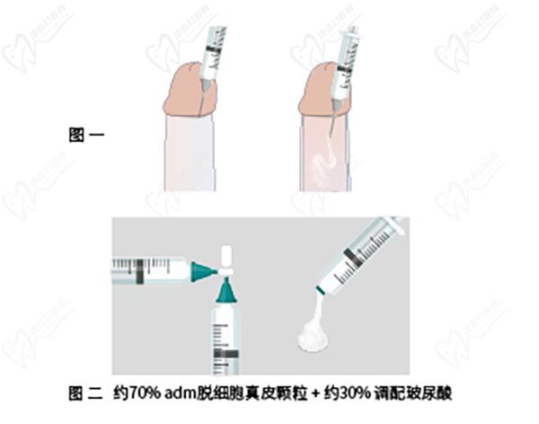 男科增粗生物補片