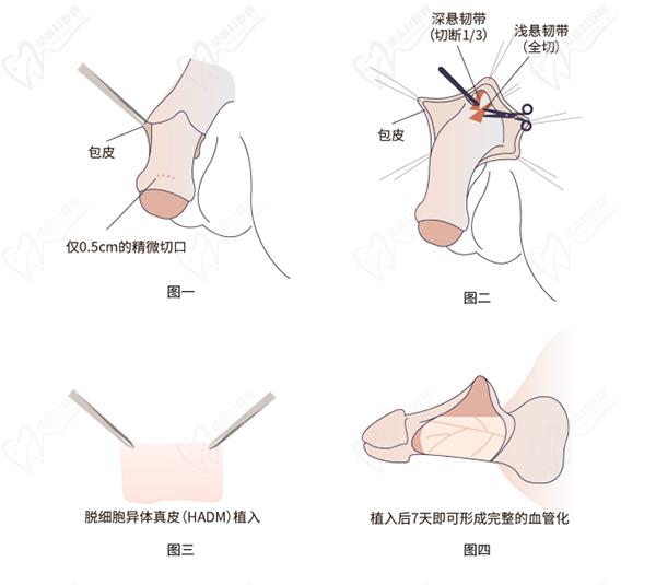 增長手術(shù)可以增長多少