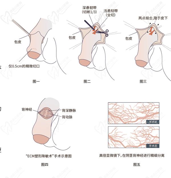 男科生殖延長要住院嗎