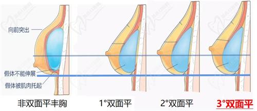 謝衛(wèi)國假體隆胸不用引流好嗎