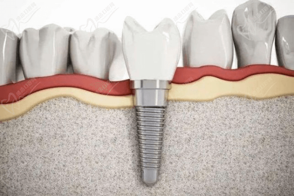 種植牙與傳統(tǒng)鑲牙哪個好？