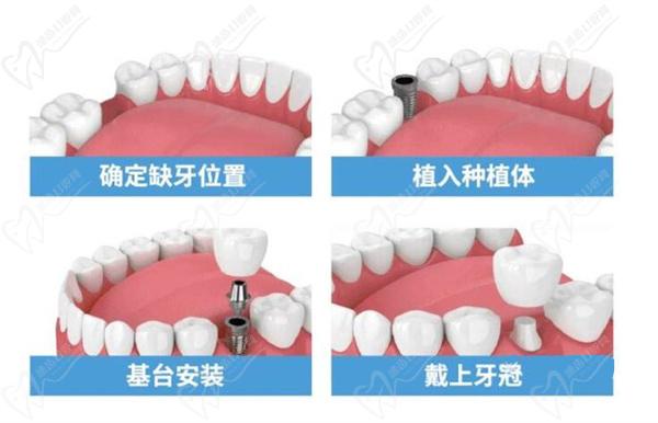 微創(chuàng)種植牙有什么優(yōu)點(diǎn)