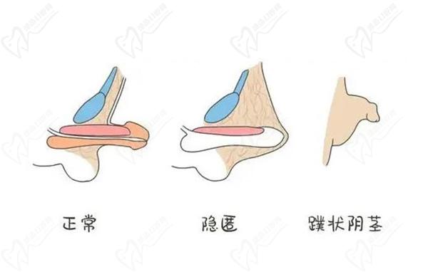 李世榮醫(yī)生做男科手術怎么樣