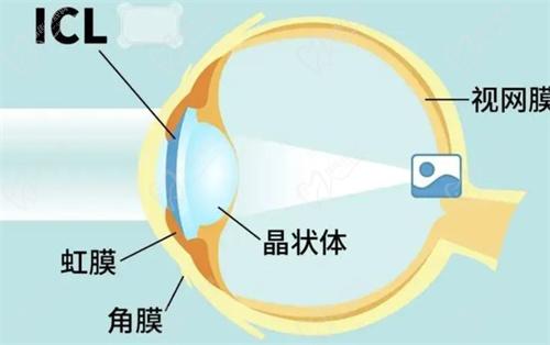 ICL晶體植入手術(shù)適合以下人群