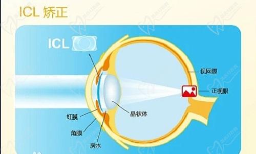 燕振國做近視手術(shù)怎么樣