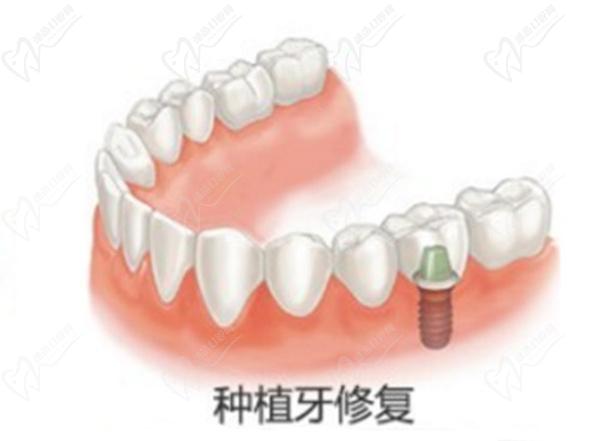 種植牙韓國和德國應該怎么區(qū)別