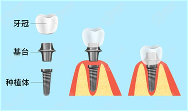 種植牙韓國和德國應該怎么區(qū)別
