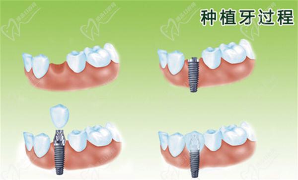 種植牙韓國和德國應該怎么區(qū)別