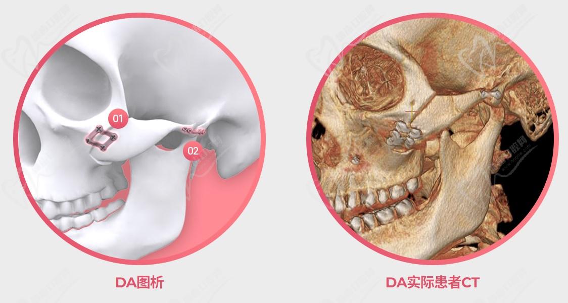 韓國(guó)da整形醫(yī)院做輪廓怎么樣