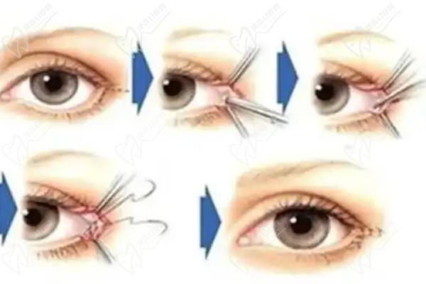 杜園園外眼角懸吊固定修復(fù)圖片