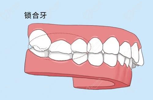 深覆合和深覆蓋的區(qū)別