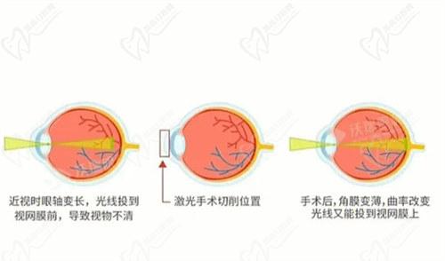 視網(wǎng)膜脫落手術(shù)費用大概多少錢2025？