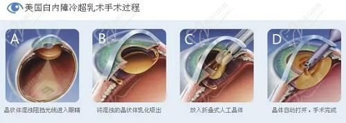 白內(nèi)障人工晶體植入可以更換嗎